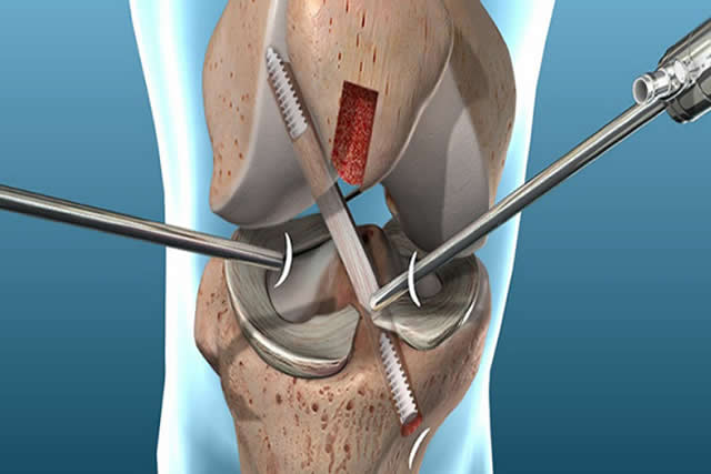 cirugia ligamentos cruzados quito
